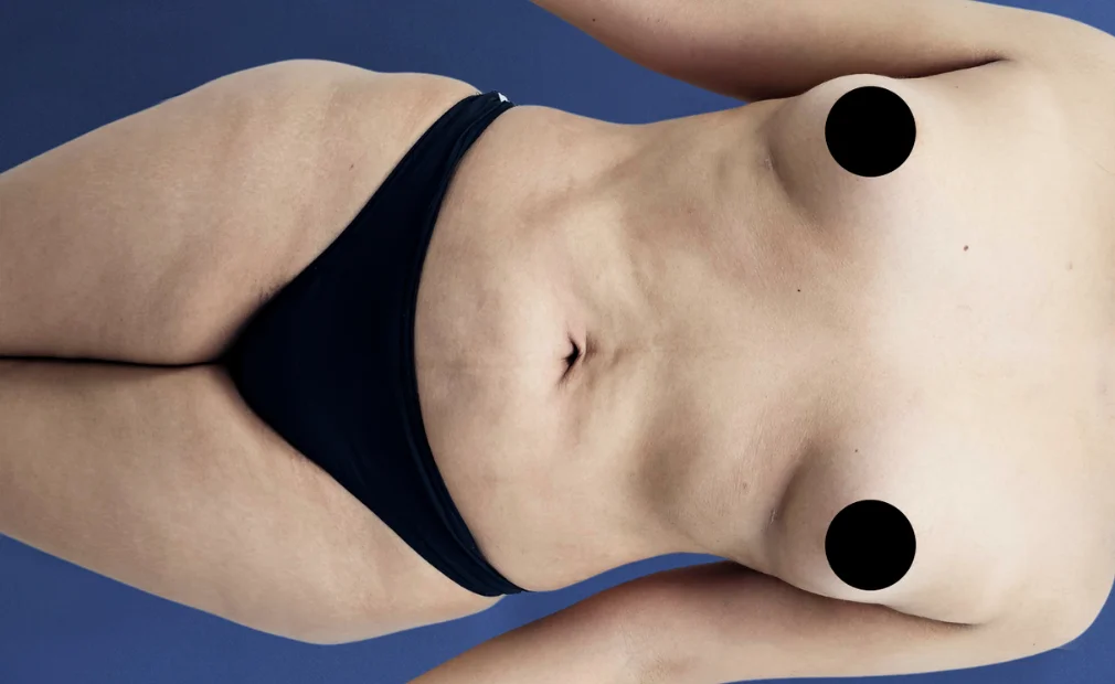 Lipoabdominoplastia