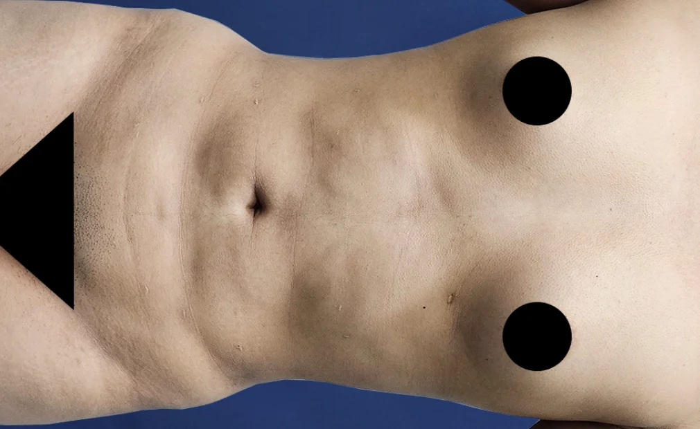 Lipoescultura